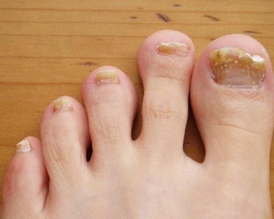 Gelbfärbung der Nagelplatte durch Pilzbefall.