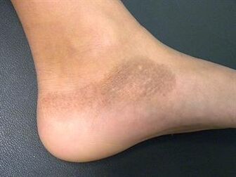 Eine Mykose der Füße geht mit einer Veränderung des Hauttons einher. 