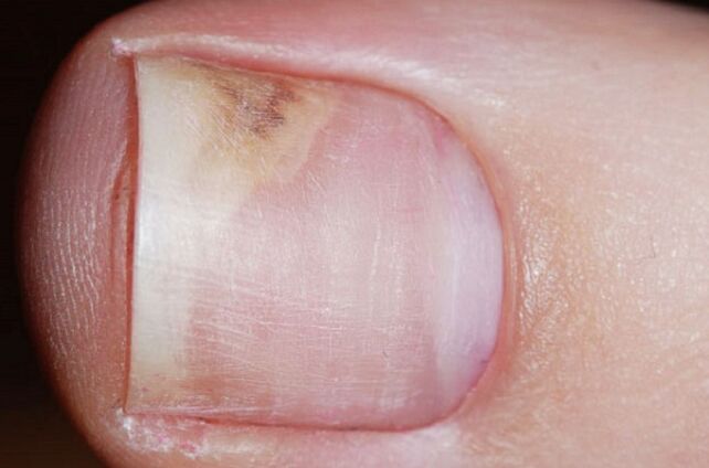 Anzeichen einer Onychomykose im Anfangsstadium sind Mattheit, Raum zwischen Nagel und Nagelbett