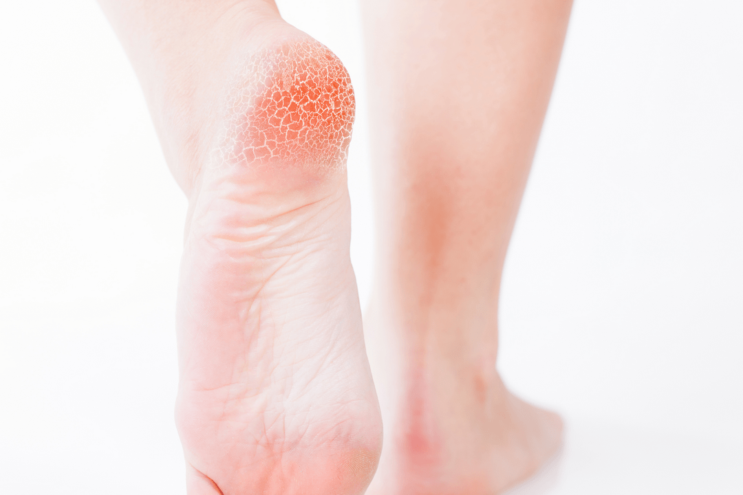 Behandlung von Fußpilz im Frühstadium