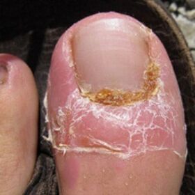 Nagelpilz