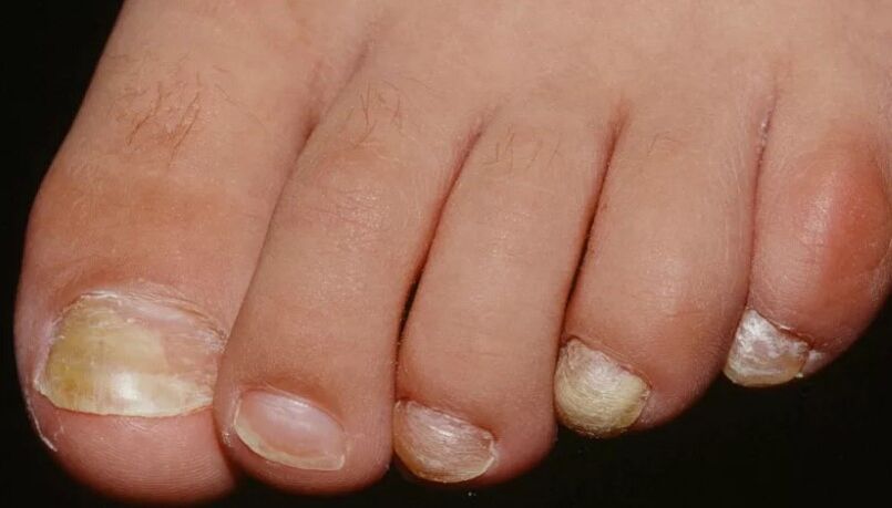Der Pilz des Nagels am Daumen