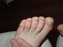 Der Nagelpilz tritt auch bei Kindern auf