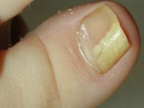 Nagelpilz