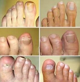 Nageldeformation