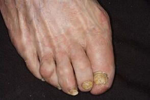 Behandlung von Nagelpilz auf Apfelessigessig