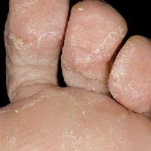 Stadien des Nagelpilzes