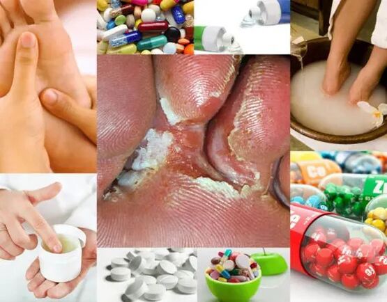 Interdigitalmykose und Behandlungsmethoden.