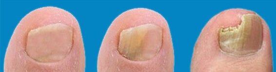 Pilzentwicklungsprozess.