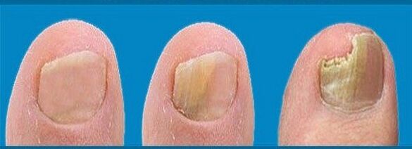 Pilzentwicklungsprozess