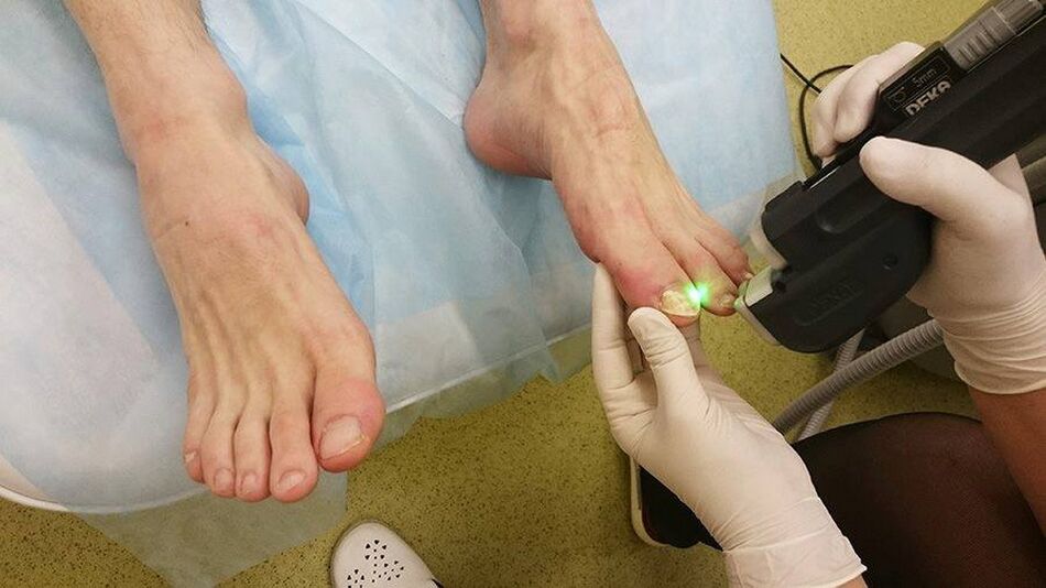 Lasertherapie bei Nagelpilz.