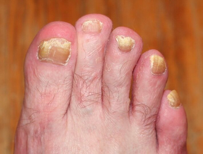 fortgeschrittene Form des Nagelpilzes