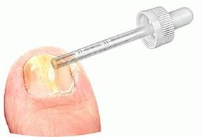 Tragen Sie medizinische Tropfen auf einen vom Pilz befallenen Nagel auf.