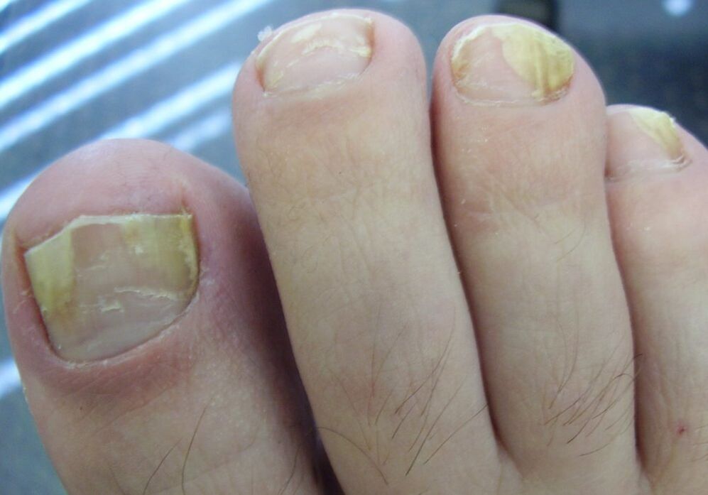 Gelbe Farbe der Nagelplatte im zweiten Stadium der Pilzinfektion.