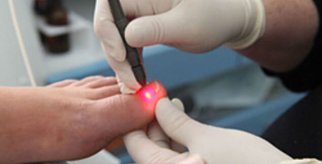 Lasertherapie bei Zehennagelpilz.